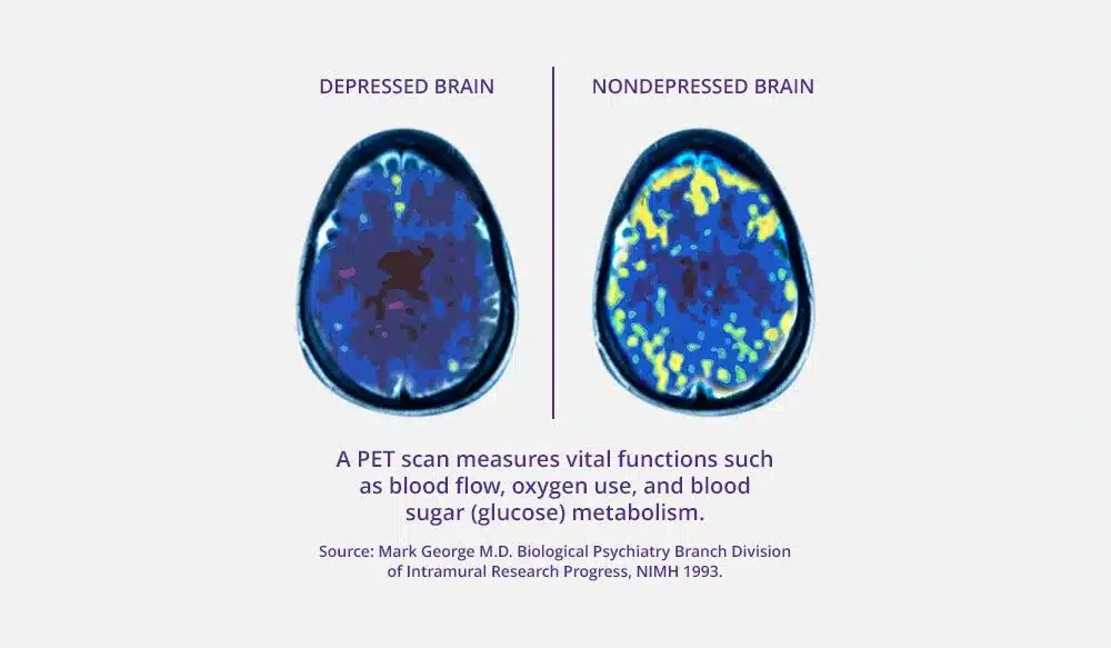 PET brain scan images showing activity in mood-regulating regions of the brain